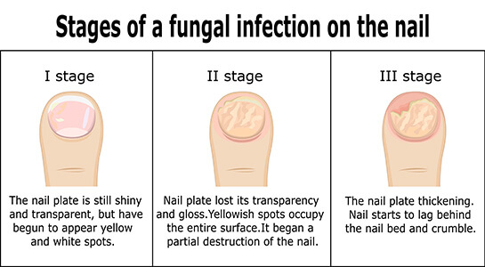 Black Toenail Fungus Causes Home Remedies Treatments And More