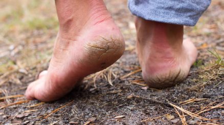 Best Home Remedies for Cracked Heels