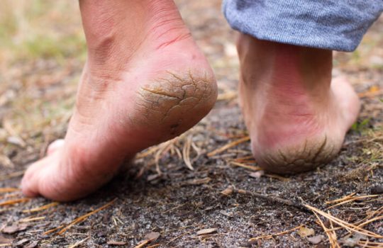 Best Home Remedies for Cracked Heels