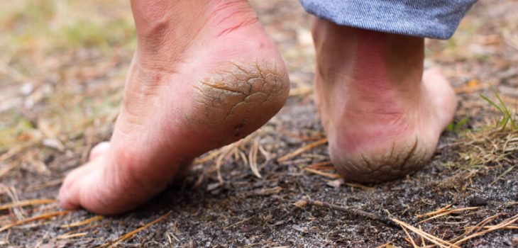 Best Home Remedies for Cracked Heels