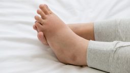 How to Deal with Swollen Feet