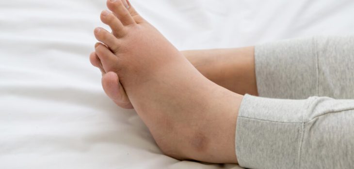 How to Deal with Swollen Feet