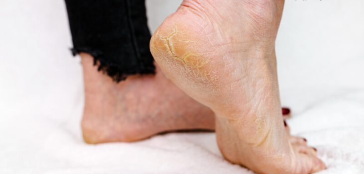 How to Prevent and Treat Cracked Heels