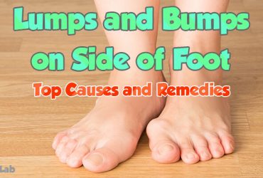 Lumps and Bumps on Top of Foot: Causes, Symptoms, and Treatment